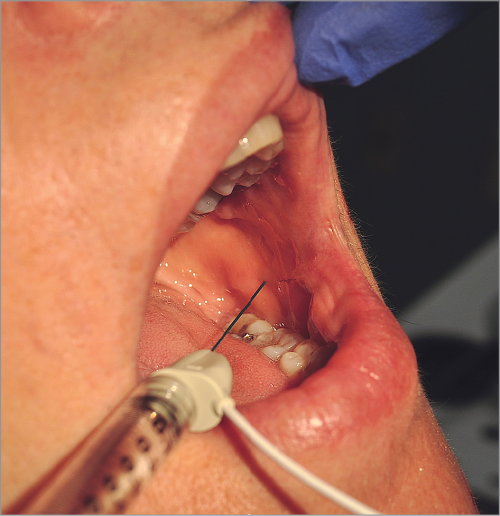 BT Treatment of the Buccinator Muscle for Facial Synkinesis