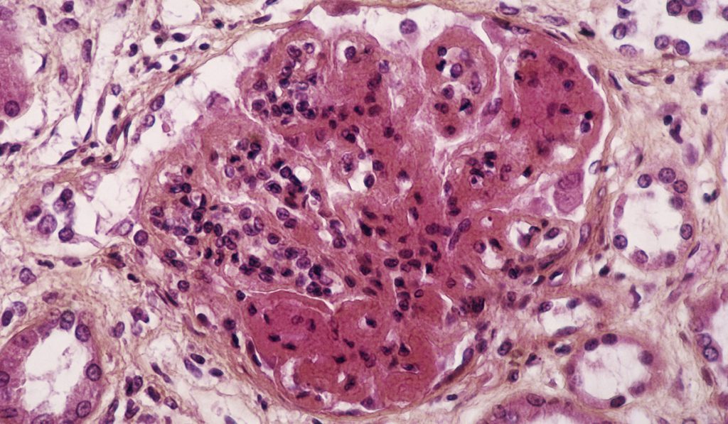 Light micrograph of a section through a glomerulus (blood filtration structure) from kidney tissue in a case of SLE.