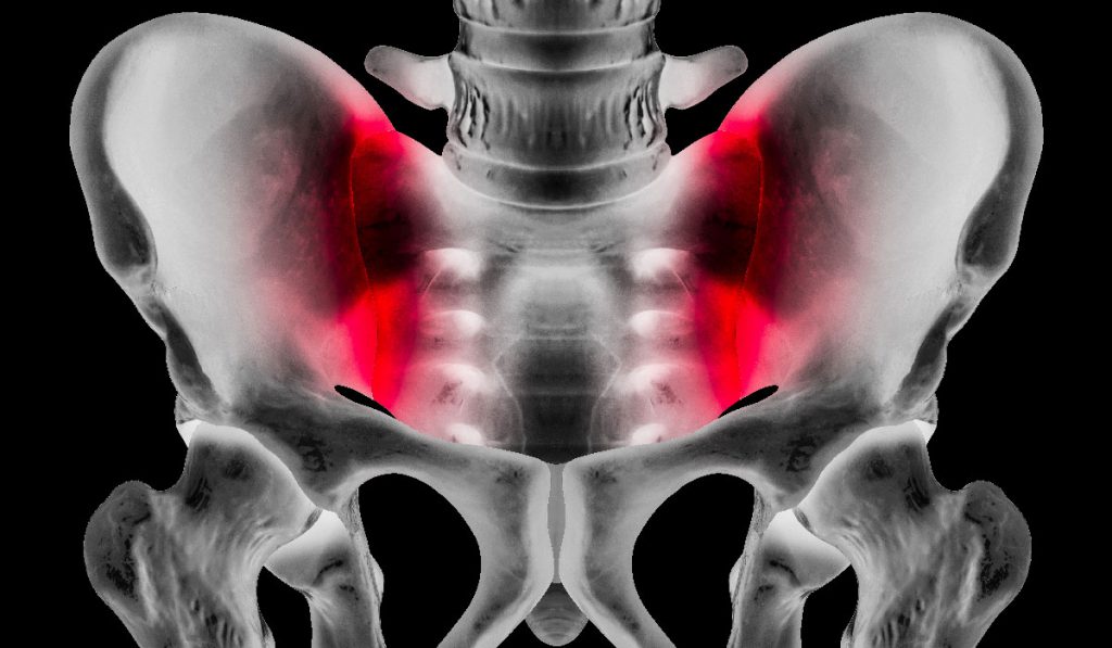 Anterior X-ray of pelvis showing sacroiliac joint pain