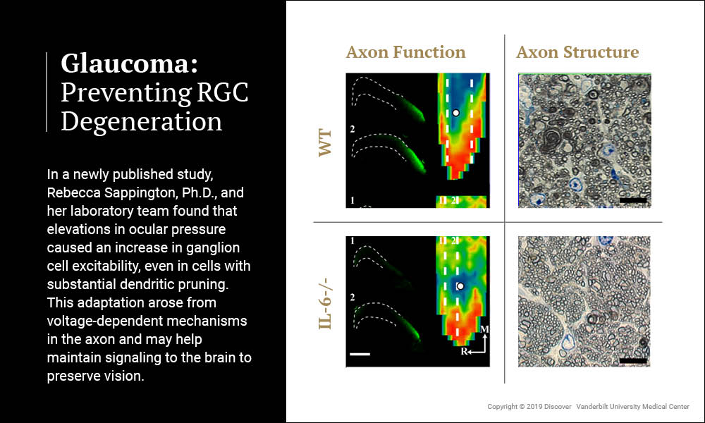 Graphic on preventing RGC degeneration in glaucoma patients