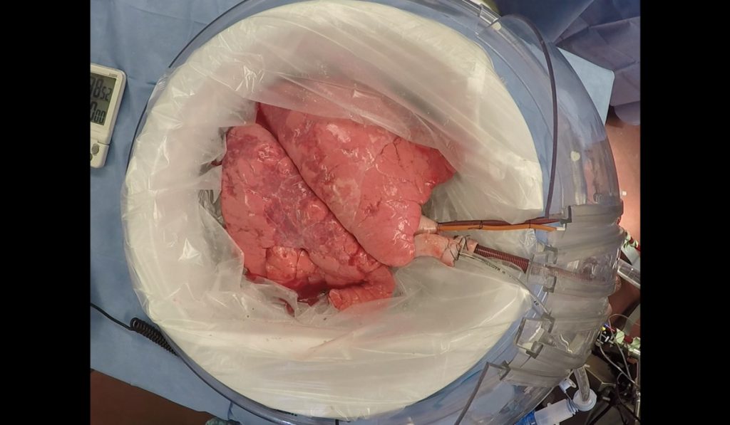 Donor lungs in extracorporeal cross-circulation.