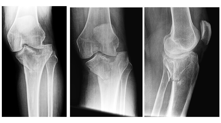 Insights into Complex Tibial Plateau Fractures