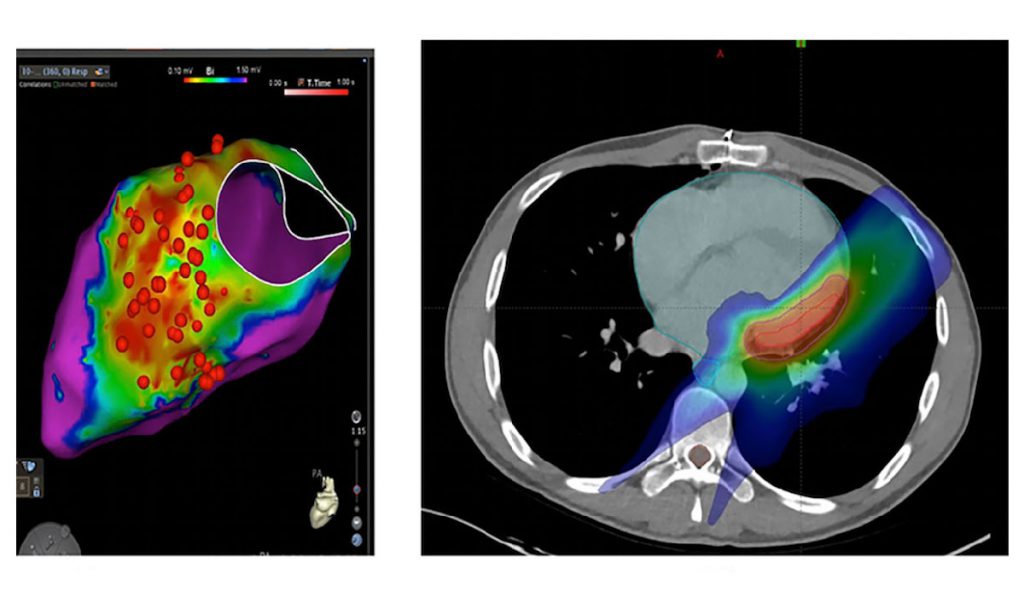 Electroanatomic map (left panel) and cross-sectional view of SBRT plan constructed on a CT image (right panel).