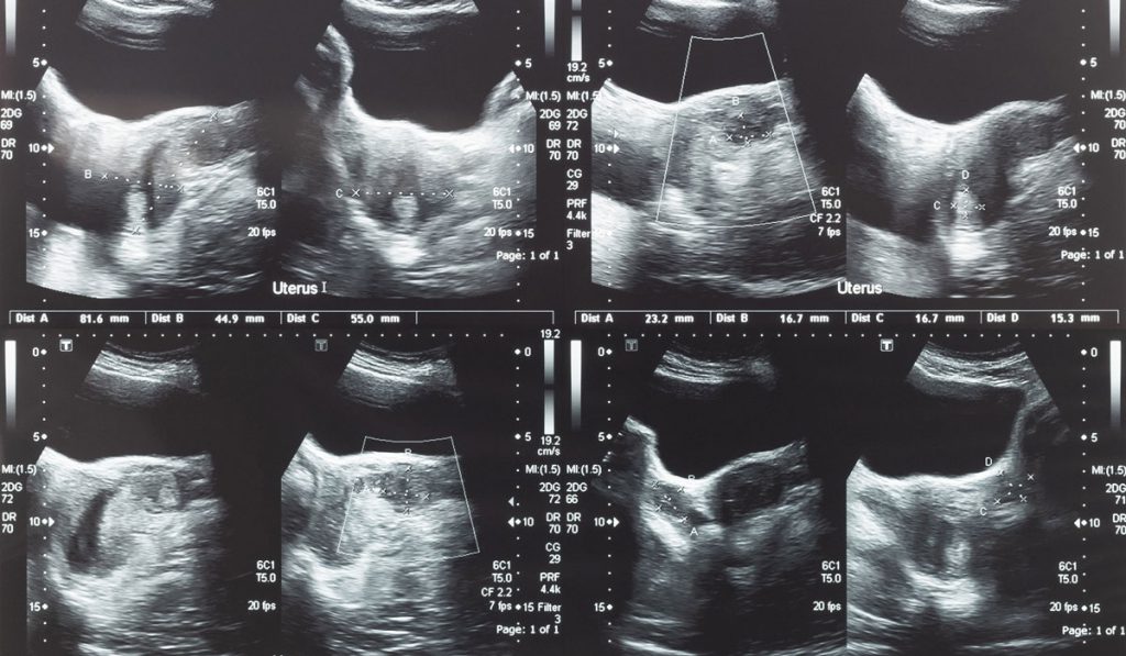 Ultrasound image of lower abdomen, ovary and uterus with tumor or uterine fibroid, leiomyoma