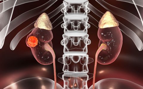 Championing Research for Non-clear Cell Renal Cancer