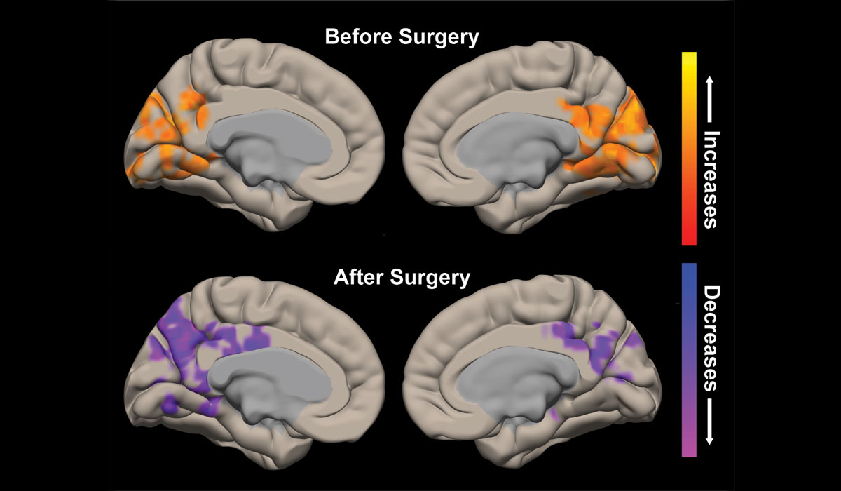 Temporal Lobe Resection Improves Brain Connectivity