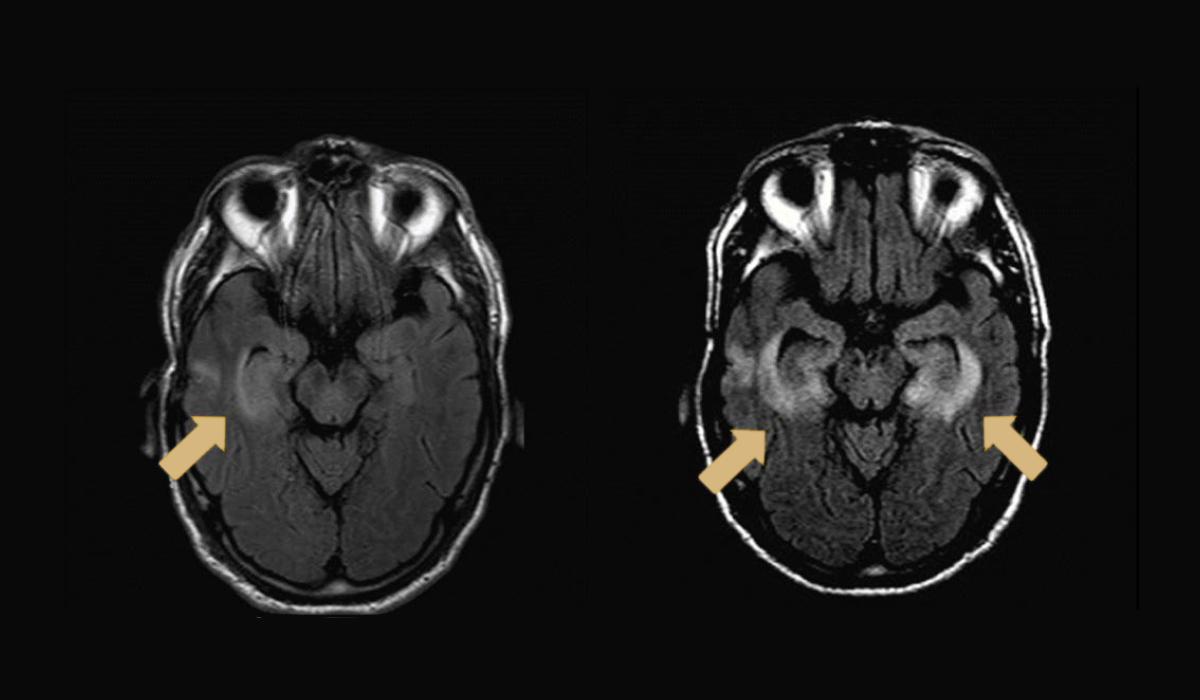 Encephalitis: Rare Side Effect of Immunotherapy