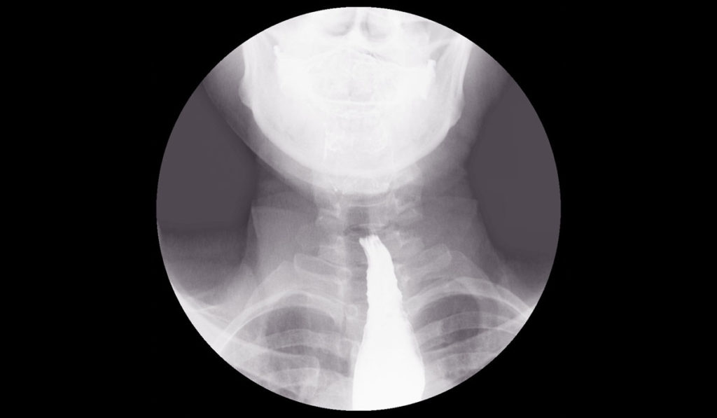 X-ray analyzing throat