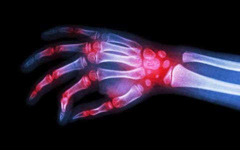 X-ray of human hand as scientists consider using biologics for rheumatoid arthritis.