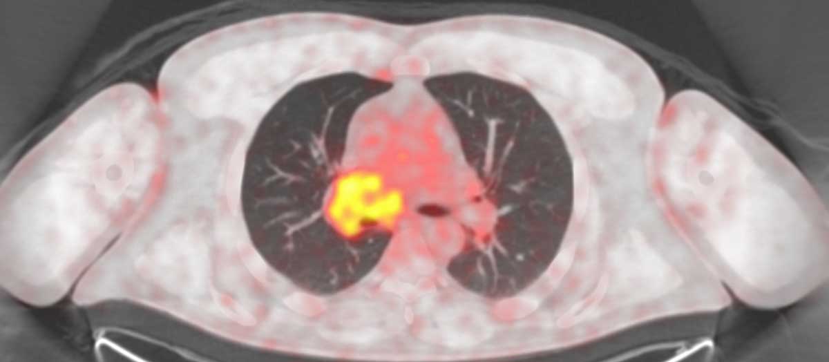 PET Scans to Reveal Whole-body T Cell Activity