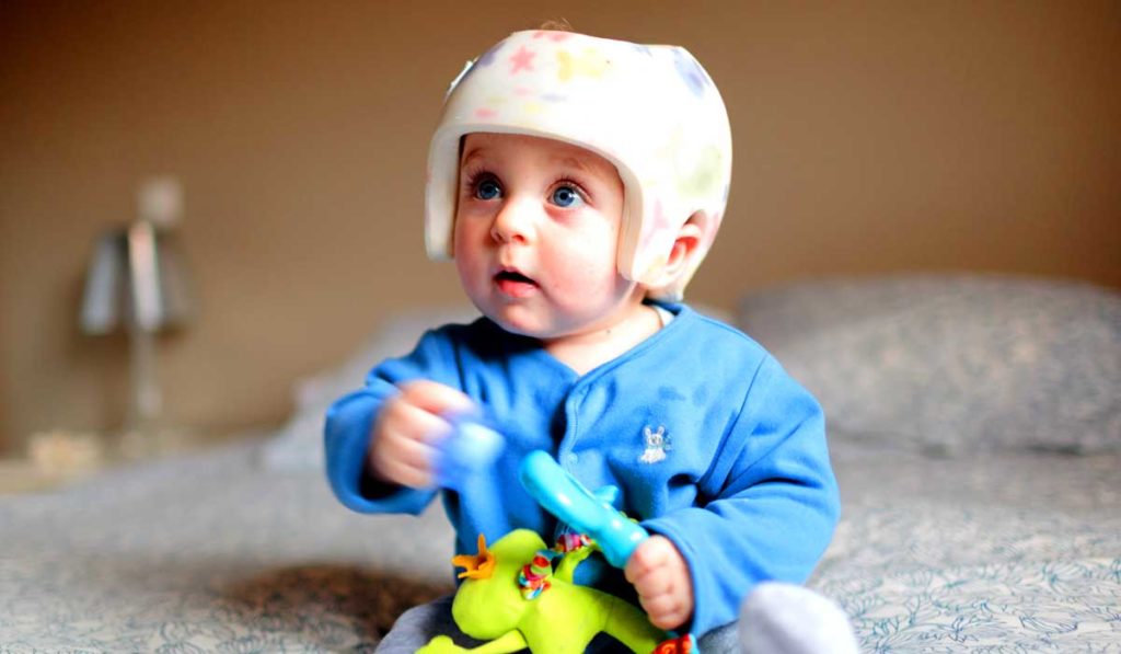 Baby with craniosynostosis wearing helmet.