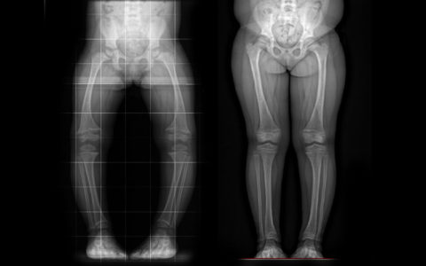 X-ray of child using burosumab trial to treat bone disease.