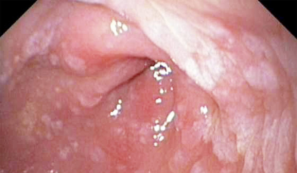 Metaplasia in the gastric antrum
