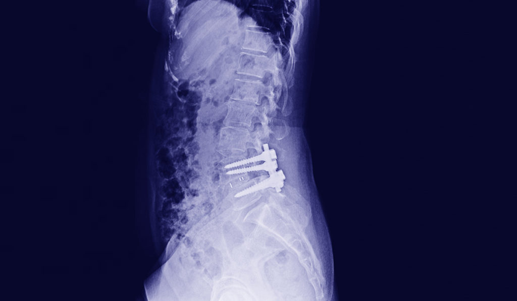 X-ray of the pelvis and spinal column ,side view Post Open Reduction Internal Fixation with internal bone rod, plate and screw by Orthopedic surgeon.
