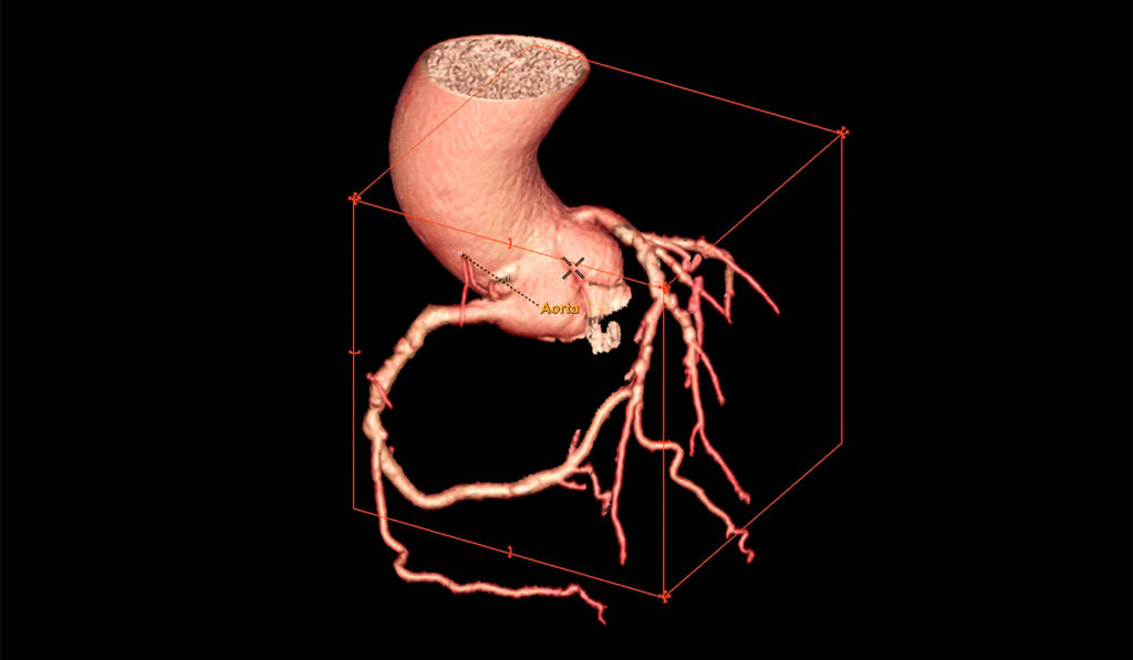 CTA Coronary artery 3D rendering image or coronary tree . CT angiography for diagnosis of vessel coronary artery stenosis .