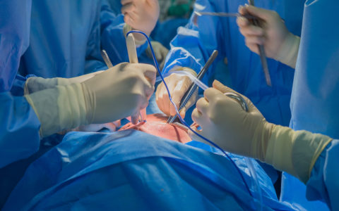 Doctors team wear blue coat perform heart surgery at the operating room in the hospital.