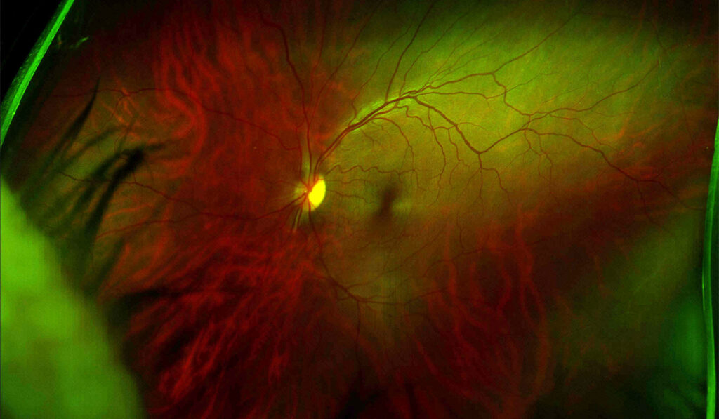 Medical scan of the eye