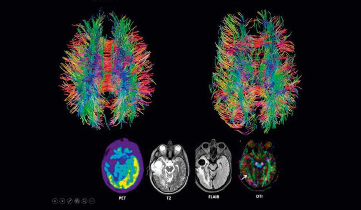 Diffusion Tensor Imaging in Traumatic Brain Injury