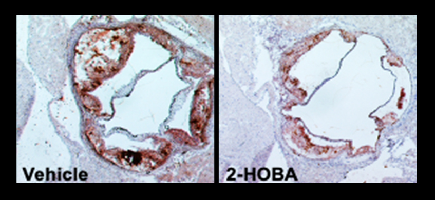 2-HOBA Could Prevent Atherosclerosis Where Statins Fail