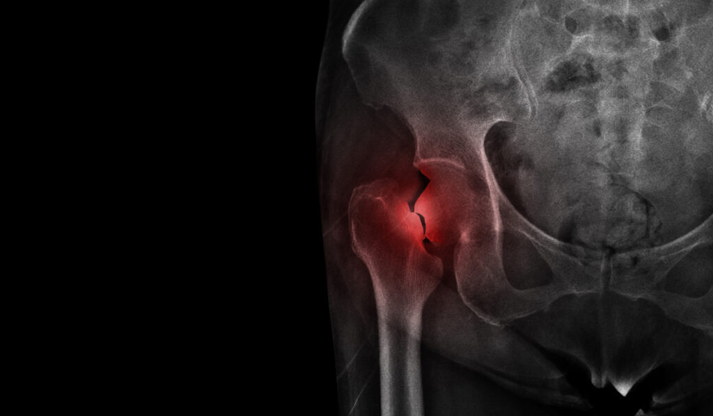 X-ray of a hip joint
