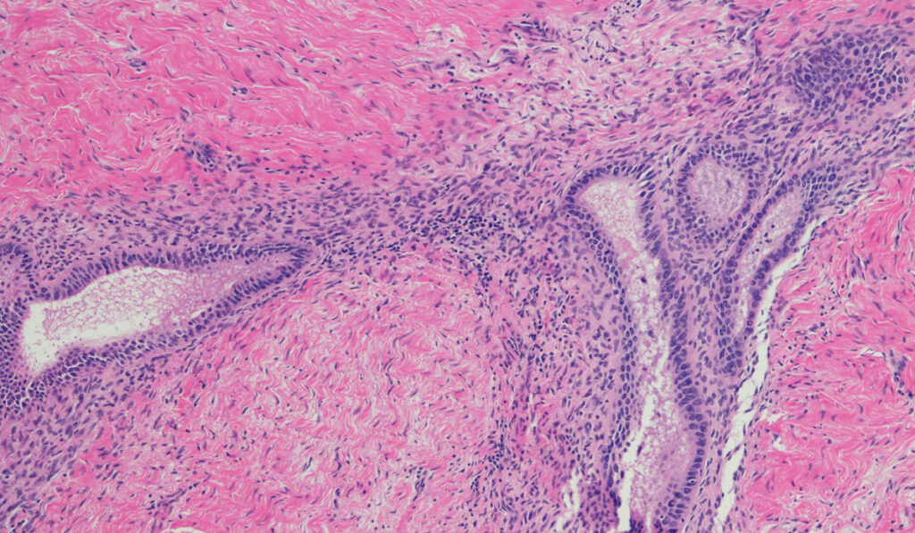 Cell image of endometriosis.