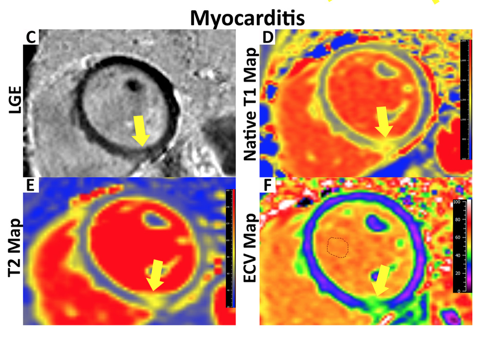 COVID-19-related Myocarditis in Athletes
