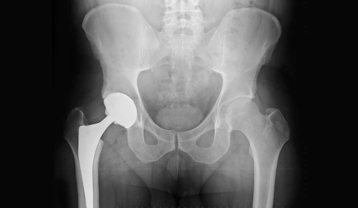 Total Hip Replacement Surgery, Direct Anterior Approach (DAA)