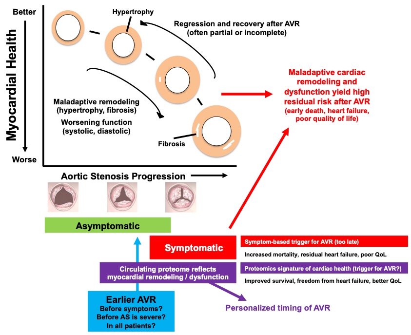 The Evidence for Earlier TAVR