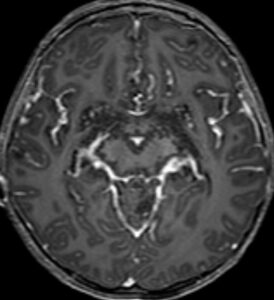 MRI scan of a pediatric patient with a disseminated low-grade glioma. 