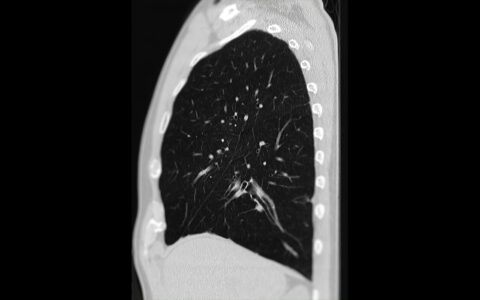 Lung CT with nodules