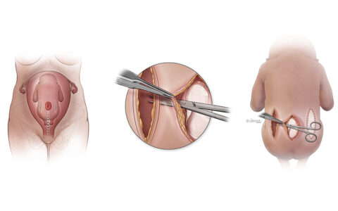 Illustration of surgery