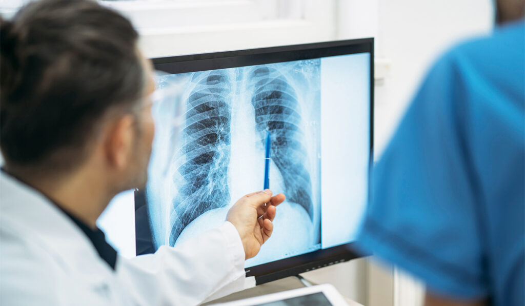 Doctor pointing at X-ray of lungs