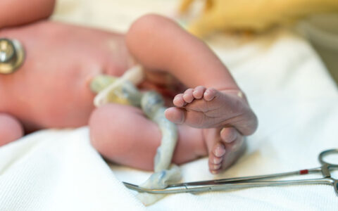 Photo of a new born baby where the focus is on feet and toes. The umbilical cord is there with surgical scissors attached. The face of the baby is not in the photograph. Body color is pink and feet are slightly purple.