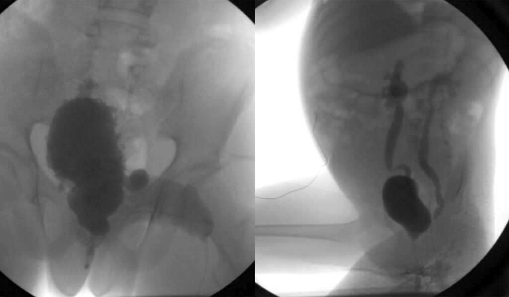 Fluoroscopic images showing bladder trabeculation (left) and vesicoureteral reflux (right) in patients with spina bifida.