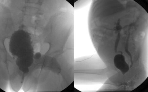 Fluoroscopic images showing bladder trabeculation (left) and vesicoureteral reflux (right) in patients with spina bifida.