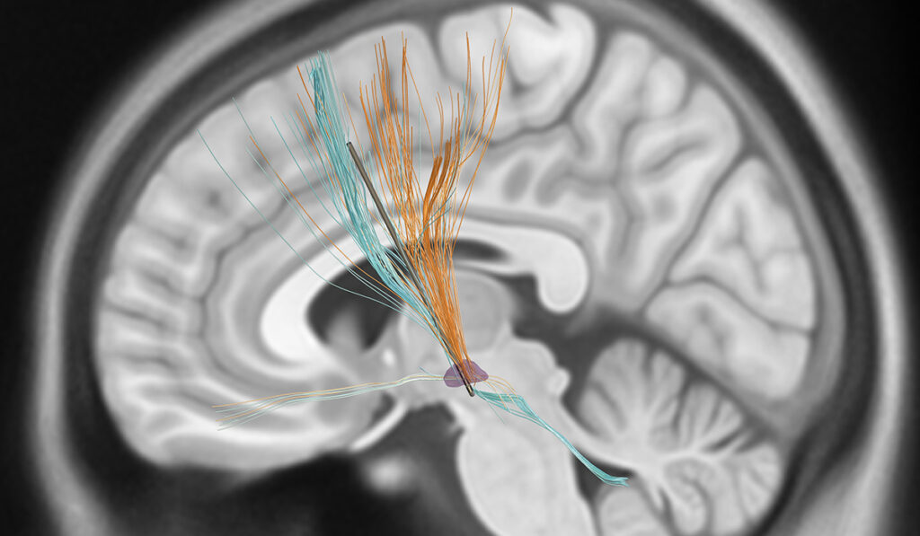 Illustration of Electrode in place for neural stimulation.