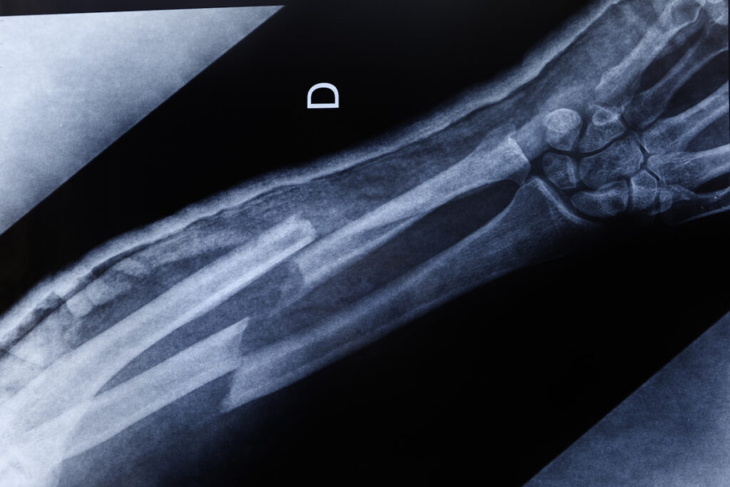 An x-ray of a double fracture in the forearm.