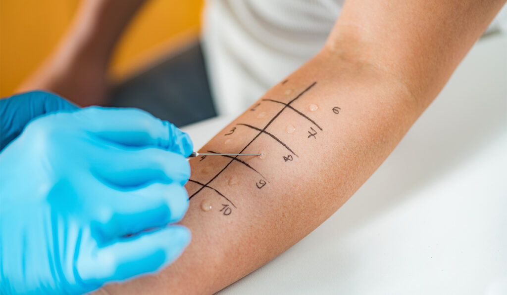 Skin prick allergy testing