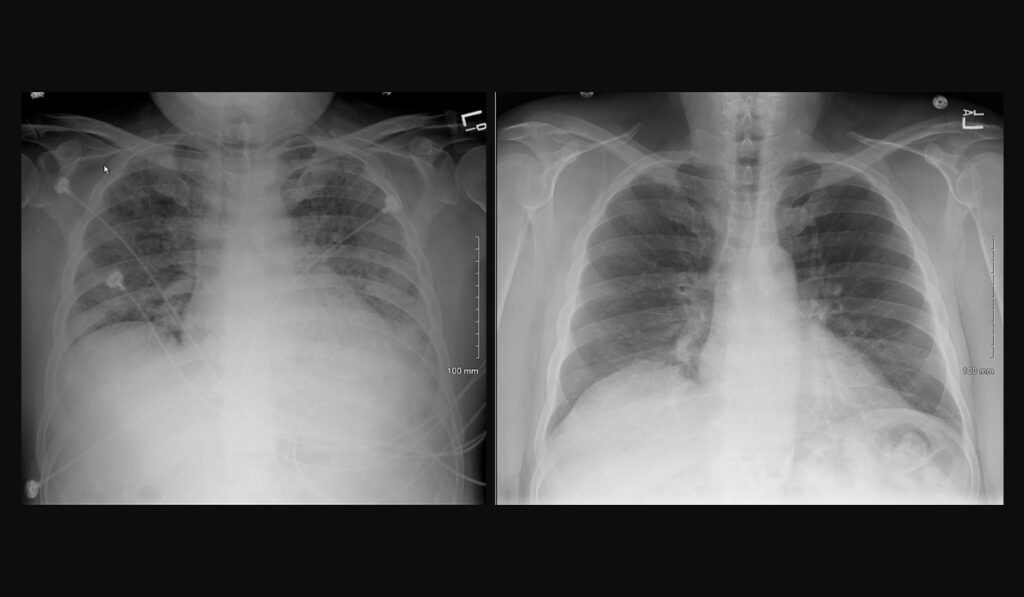 Interstitial pulmonary infiltrates vs. healthy lung