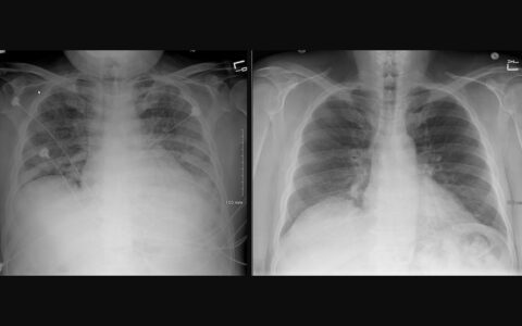 Interstitial pulmonary infiltrates vs. healthy lung