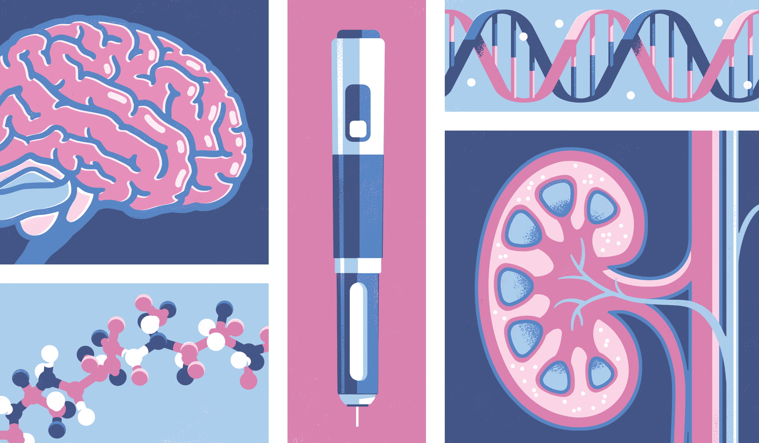Using Glp-1 Agonist Medications To Slow Progressive Renal Disease